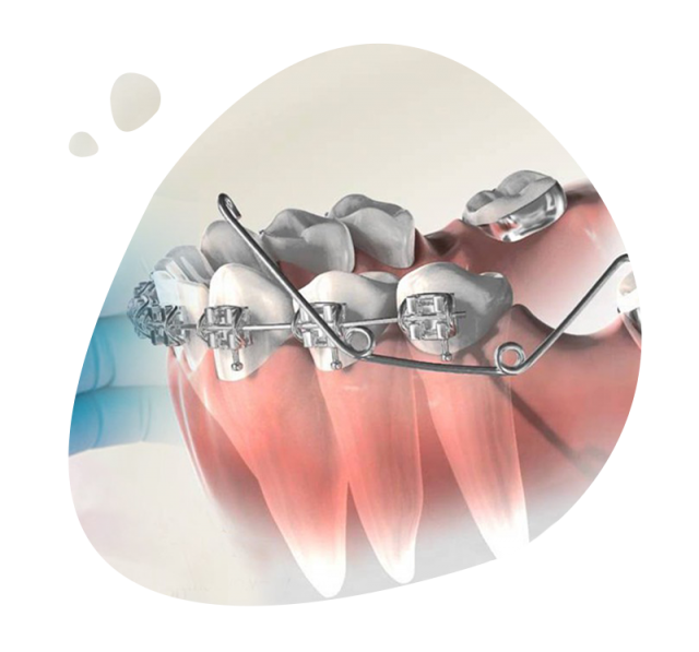 https://www.expertsdentalclinic.com/wp-content/uploads/2021/05/ortodonti-640x597.png
